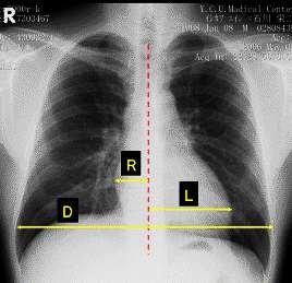 心胸郭比 (CTR:Cardio Thoracic ratio) CTR(%)=(R+L)/D 100 正常値 :35~50% A)