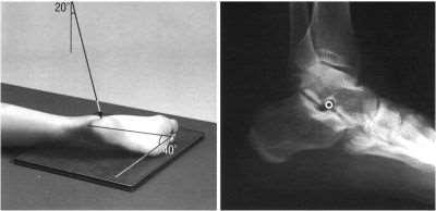 アントンセン法 ( 距踵関節撮影 ) 目 的 距踵関節と踵立方関節とを描出する 体位 側臥位で頭足方向斜位撮影 下腿部の長軸を撮影台の中心線に合わせ