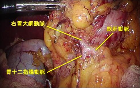 胃の切除範囲は がんの位置とその進行度によって決めます 基本的には がんの位置が幽門部に近い場合は幽門側胃切除を