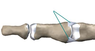 橈側側副靱帯が機能的に重要 (