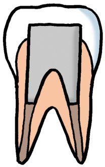大きく深い虫歯の場合 虫歯を削って歯のほとんどを失ってしまった場合 神経がなくなったため