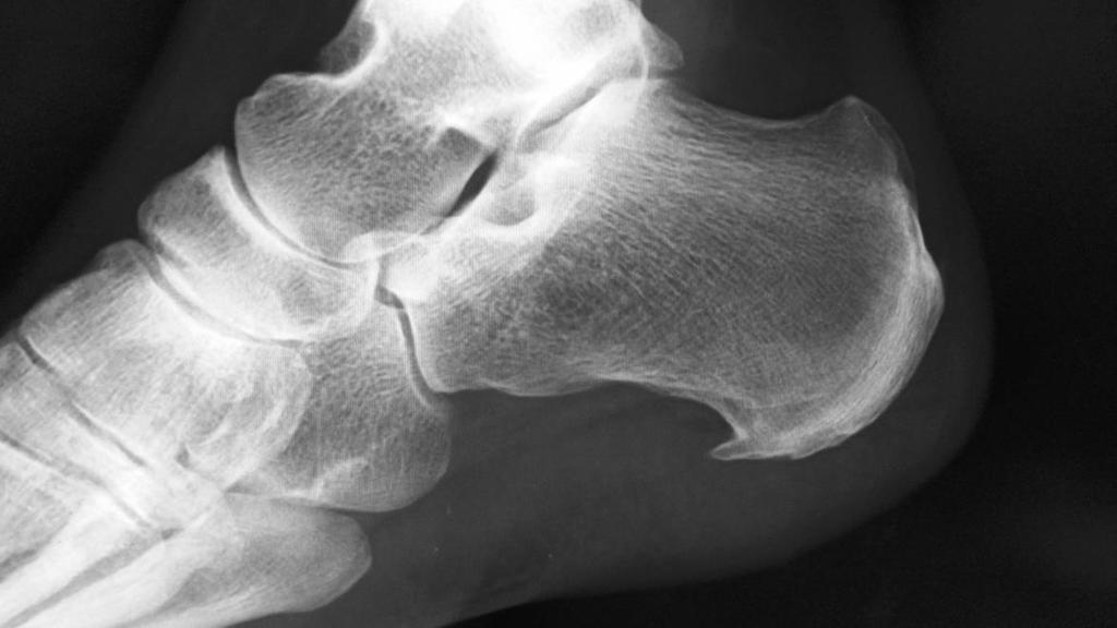 足底筋膜炎 足底筋膜の踵骨停止部の変性による踵骨部痛 起床後の一歩目に疼痛