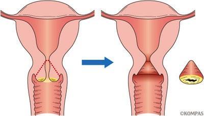 子宮頸部円錐切除術 初期の子宮頸がんあるいは高度異形成 ( 前がん状態 ) では 子宮を残して病変部のみを切除する治療 ( 円錐切除 ) が施行される 頸管縫縮術 ( 早産予防 ) CIN で外科的介入を受けた女性における早産のリスク ( 手技による比較 ) 治療を受けた女性 未治療の女性 (