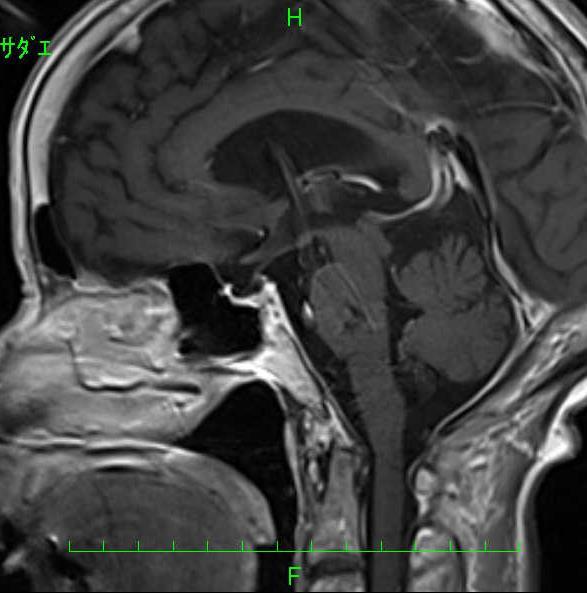 頭部 MRI