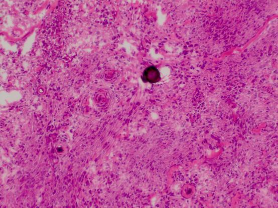 神経鞘腫に特徴的な所見は明らかでない また 髄膜腫では細胞集塊とともに散在性細胞を認めるが