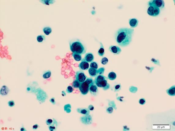 ウイルス感染細胞 (Decoy cell) 3. 尿路上皮乳頭腫 4.