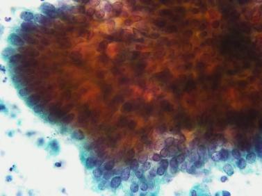 Adenocarcinoma: 内頸部型粘液性腺癌