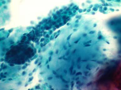 多形腺腫組織診断 : 多形腺腫解説 : 背景に粘液腫様間質を伴い それに混在するかのように上皮性細胞集塊や線維性細胞がみられ