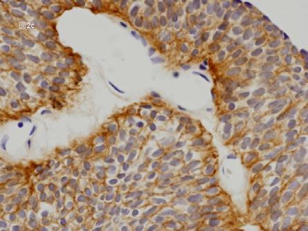 図 2c 非浸潤性尿路上皮癌における EGFR 腫瘍細胞の膜に沿って強い反応が見られる 図 2d 連続切片における p53 腫瘍細胞の核に反応が見られる 図 2e 浸潤癌例における EGFR 図 2c と同様の反応が認められる 図 2f 連続切片における p53