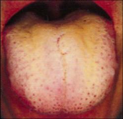 誤嚥性肺炎のリスク高 味覚の低下 口臭