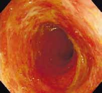例にすぎず ほとんどは 図 2 に示すように 小潰瘍やびらんを呈する症例であり 内視鏡像で CMV 陽性