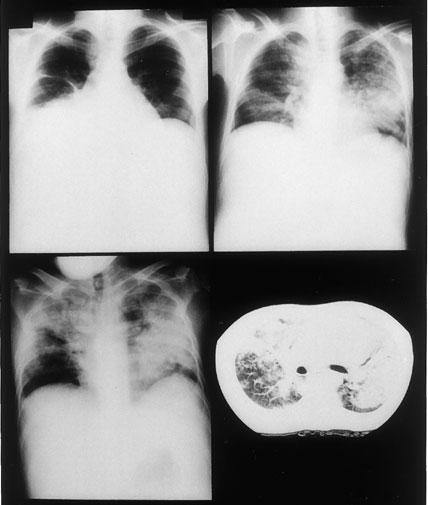 Fig. 1 a b c d a; Chest X-ray on admission.