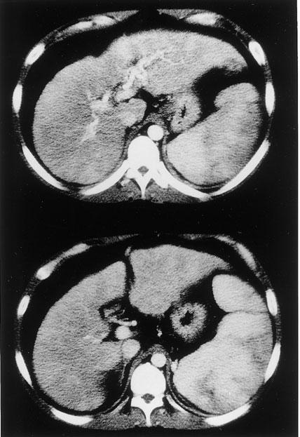 c, d; Chest X-ray and CT scan shows exacerbation of congestive shadow. Fig.