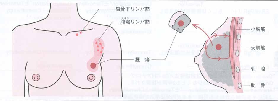乳房温存療法 (