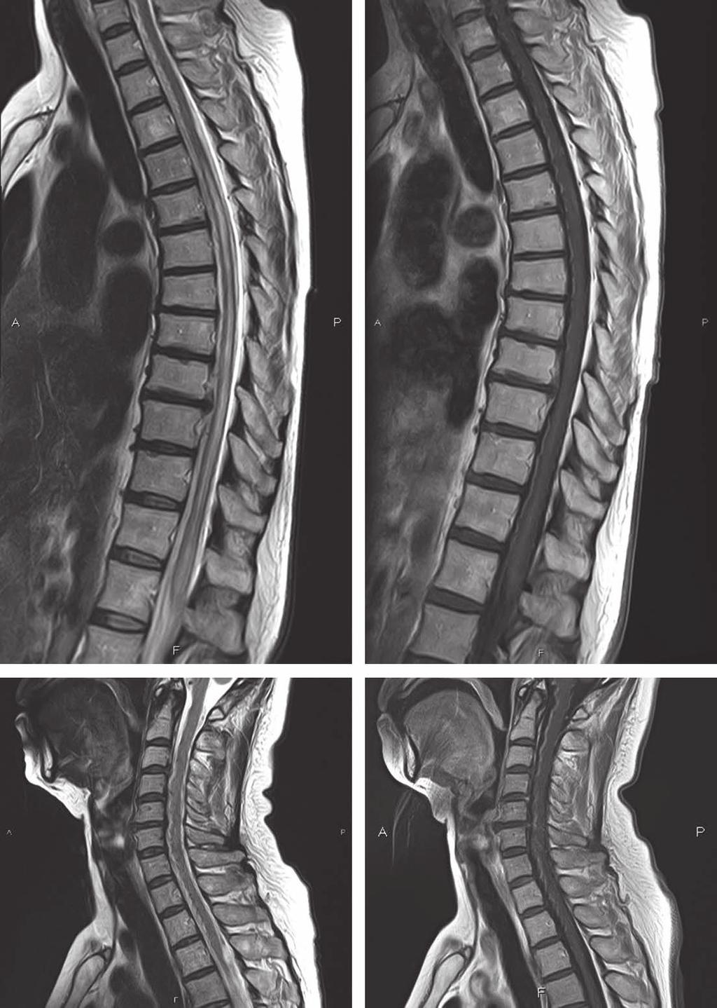 56:38 56 巻 1 号 (2016:1) MRI images of spinal cord. (A): Thoracic sagittal T 2 -weightd images (1.