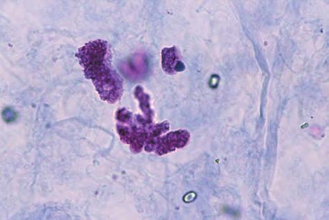 53 尿細管上皮細胞 40 無染色 Renal tubular epithelial cell 40 No staining アメーバ偽足型の尿細管上皮細胞である 黄色調で細胞質辺縁構造は顆粒状を示し, 細胞質辺縁は深い切れ込みがあるアメーバ偽足状を呈している This is an amoeba pseudopod-type renal tubular