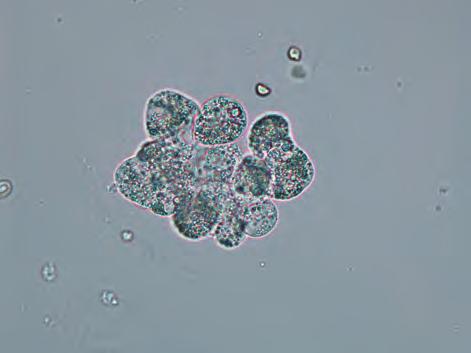 oval fat body. The nuclei are small and blue. The cytoplasm is granular and is stained reddish purple. It is thought to be derived from renal tubular epithelial cells (saw type).