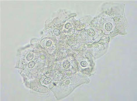 と同一例 尿細管腔内の尿細管上皮細胞は, ヒトポリオーマウイルスのマーカーである SV40 免疫染色で陽性を示している The same example as Figure 3.170.