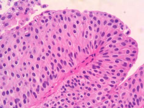 papillary urothelial carcinoma. Small cells constituting the conglomerate may be an urothelial cell line based on the marginal structure.