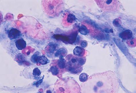 of red blood cells appear scattered. In such cases, non-epithelial malignant cells are suspected and should be confirmed by S or MG staining. A case of acute promyelocytic leukemia. Figure 3.