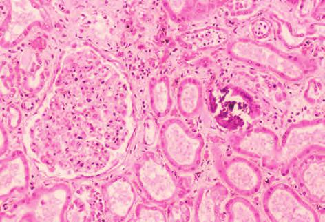 288 大食細胞円柱 40 S 染色 Macrophage cast 40 S staining 基質内の大食細胞は S 染色で細胞質が赤紫色に染色されている 細胞質辺縁は不明瞭である The cytoplasm of the