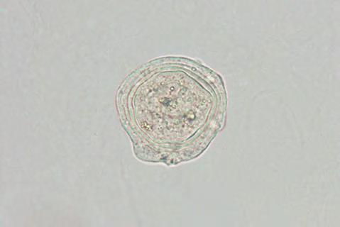 395* 桑実細胞 ( マルベリー細胞 ) 40 S 染色 Mulberry cell 40 S staining 渦巻状の特徴的な構造である桑実小体 ( マルベリー小体 ) が細胞内に多数存在するものを桑実細胞 ( マルベリー細胞 ) という