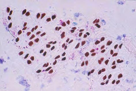 urine of a patient with acute prostatitis. They are similar to oval fat bodies because the macrophage cells phagocytize fat components.