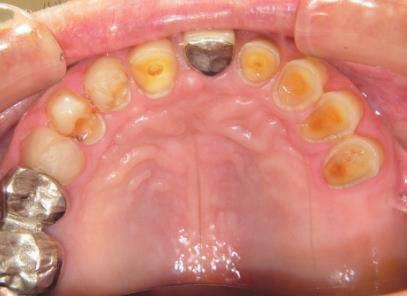 エナメル質形成不全からのむし歯 酸蝕症