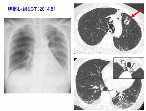 薬剤性肺炎 (BUC) の診断にて PSL25mg/ 日による治療開始 治療抵抗性で 7 月より PSL50mg/ 日に増量 徐々に軽快した 経過中肺空洞病変出現 アスペルギルス抗原 1.2(0-0.