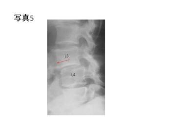 女性の2 倍の発症率 ) の腰痛はこの初期段階の場合があり 早期の MRI,CT ( 写真 4).