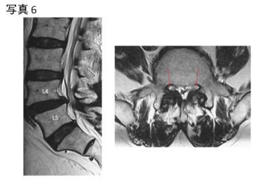 ( 偽関節 ) に至らず 慢性の腰痛を改善できる. 一方辷り症は腰椎変性により椎体のずれが生じる ( 写真 5).