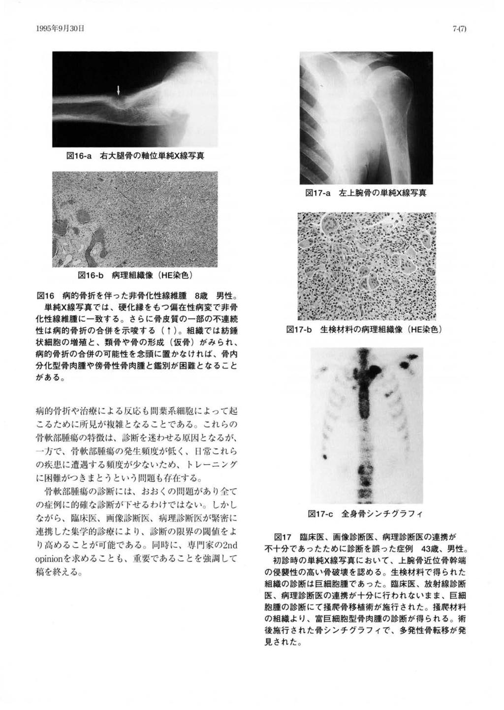 1995 年 9 月 30 日 図 16-a 右大腿骨の軸位 図 17 a 左上腕骨の 図 16 b 病理組織像 (HE 染色 ) 図 16 病的骨折を伴った非骨化性線維腫 8 歳男性 では 硬化縁をもっ偏在性病変で非骨化性線維腫に一致する さらに骨皮質の一部の不連続性は病的骨折の合併を示唆する ( ) 組織では紡錘状細胞の増殖と 類骨や骨の形成 ( 仮骨 ) がみられ