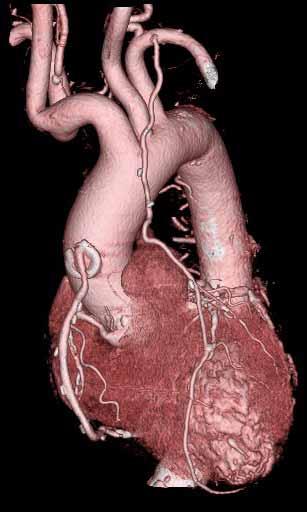 Cardiac CT: