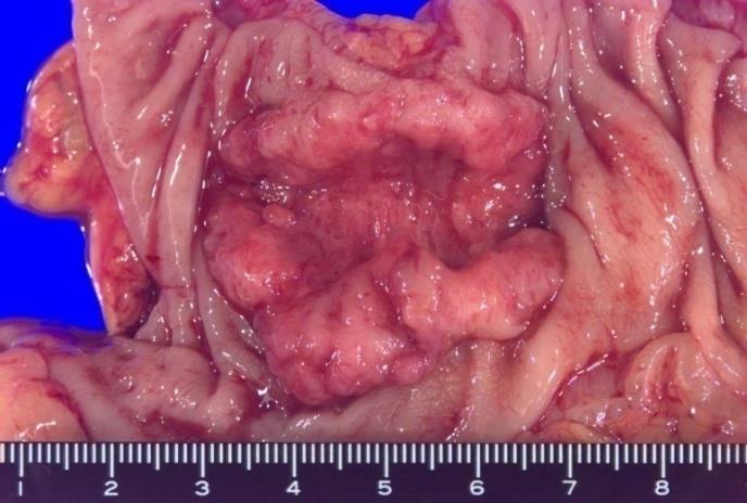 大腸がんの手術切除標本 手術後の病理検査 腸管
