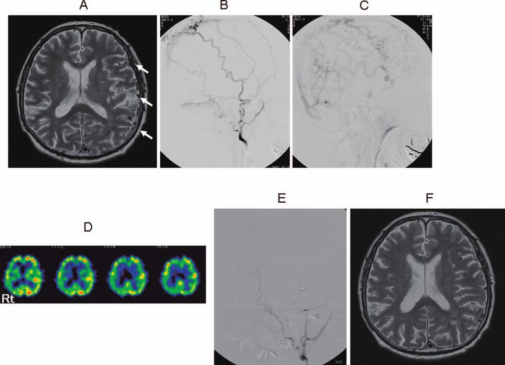 187 代表症例 80 2008 4 MRI dural AVF 2008 8 MRI Fig. 3 - ASSS TSS Fig. 3 - B,C confluence MMASTA OA SPECT Fig. 3 - D 2008 8 4 STA STA MMA 2009 4 20 OA Fig. 3.A : MRI T1 weighted image before treatment shows a lot of cortical venous dilatation.