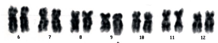 遺伝子と 22 番染色体長腕上の BCR 遺伝子が融合し BCR-ABL 遺伝子が形成される BCR-ABL