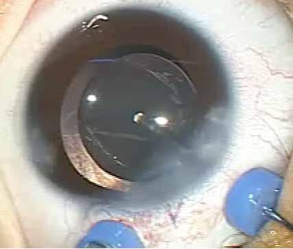トロッカーの一方に眼内への還流ラインを接続し, もう一方から27ゲージ硝子体カッターを眼内に挿入し, 後囊円形切除, 及び前部硝子体 ( 前方 1/3 程度 ) を切除した ( 図 4). その後, 前房内の粘弾性物質を除去し, 眼圧調整を行い手術を終了した.27ゲージの強膜創からの硝子体脱出や眼内液の漏出は認めず, 強膜創の自己閉鎖が得られ, 安全に手術を終了した.