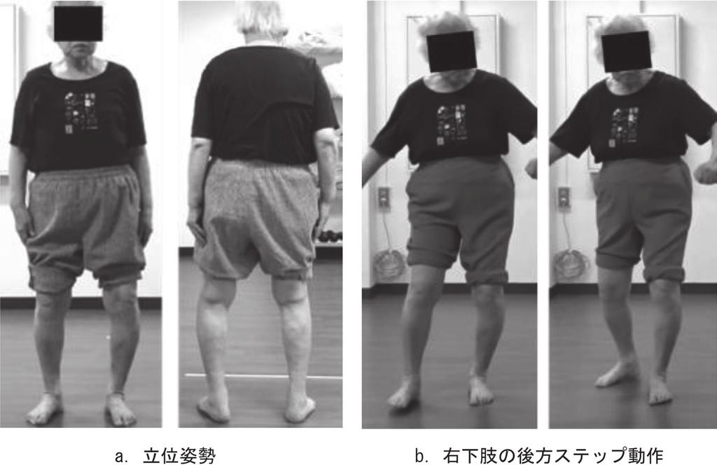 84 武凪沙, 他 5 a の左図は前方から見た立位姿勢を 右図は後方から見た立位姿勢を示しており 体幹直立位保持した立位姿勢の獲得に至った そして日本舞踊における両側股関節 膝関節を軽度屈曲させた体幹直立位での基本姿勢をとることも可能となった また b の左図のように左後足部回外位の改善により 左側体重移動時の左後足部回外による過剰な下腿外側傾斜が軽減した さらに b