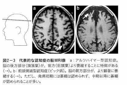 MRI アルツハイマー型認知症