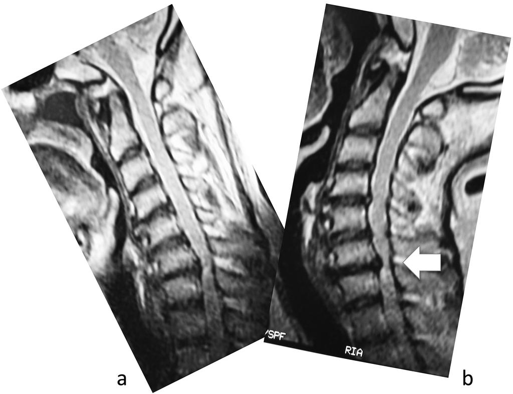 Spinal cord injury pain syndrome in cervical myelopathy Fig.1 Kinematic MRI of a patient with cervical spondylotic myelopathy.