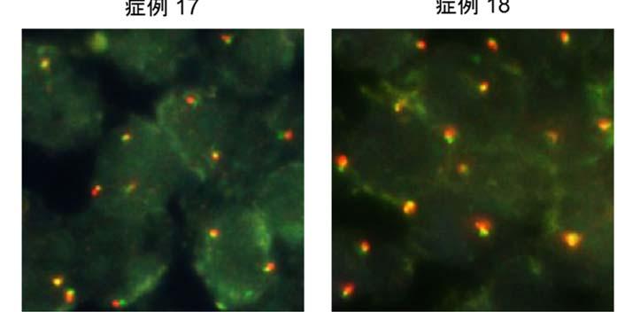 これで細胞を染色しました 正常な状態であればこの両側は隣同士なので 緑色と赤色が重なって黄色の蛍光が検出されます しかしながら MYB