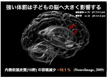 虐待が引き起こす脳の変化 ~ 脳波異常 ~ 異常脳波の割合 ( % ) 8 7 6 5 4 3 2 P<.1 P<.