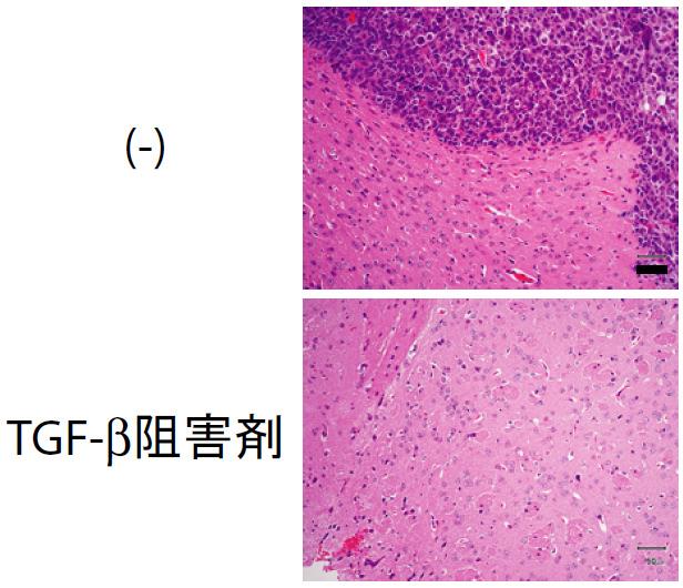 幹細胞へと転換されたことを意味する 以上の結果から TGF-βは脳腫瘍幹細胞において TGF-β-Sox4-Sox2 という新規の経路を活性化することによって その "stemness を維持し さらに高い腫瘍原性能の維持に寄与していることが明らかとなった 本研究によって示されたモデル ( 下図 ) は 他の腫瘍幹細胞及び正常幹細胞を含めても 全くの新規のモデルである さらに本申請者は その