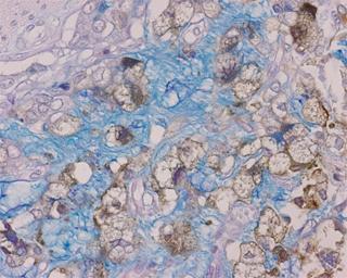 ウサギポリクローナル抗体とアルシアン青 PAS 重染色 ( 胃癌 ) 抗 CEA 抗体で免疫染色後 (DAB 発色 )