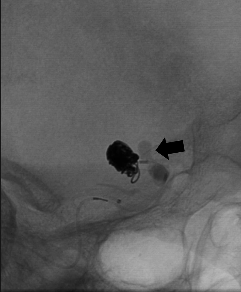 during embolization of unruptured IC-PC aneurysm in a 73-year-old