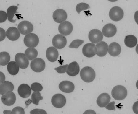 設問 4-6 回答数回答率 (%) リンパ球 33 78.6 異型リンパ球 3 7.1 有核赤血球 3 7.1 赤血球系その他の 1 2.4 異常リンパ芽球 1 2.