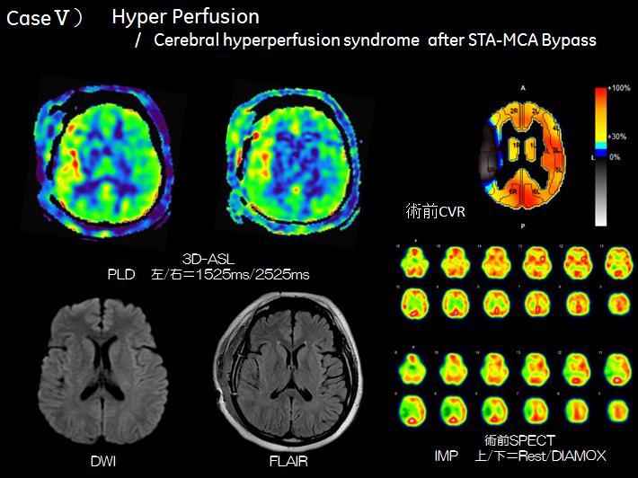 3 過灌流 (Hyper perfusion) の症例 CaseⅤ) 右 STA-MCA バイパス術後 ( 図 8) 右中大脳動脈閉塞のアテローム血栓性脳梗塞で一過性脳虚血発作を繰り返し右