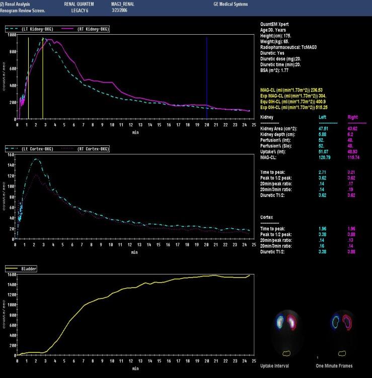 -3. MAG3 QuantEM Genie,Expert 法 Renogram Review 画面 腎臓全体のカーブ 利尿剤投与時間 患者さま情報 本の黄色いロケータは UpTake 値計算の範囲を表します 腎臓皮質のカーブ 3 解析結果 膀胱のカーブ MAG-CL (ml/(min*.