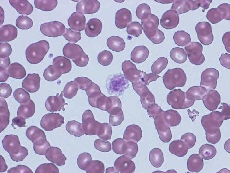 各種血球数偽高値の原因になります これらを疑う場合 塗抹標本を直接目視して白血球数が本当に増えているかを確認します ( 図 ₁)