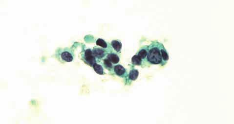 上 : spindle な細胞がみられる 体腔液中の細胞は adenocarcinoma との鑑別が難しい場合が多く 本例のように